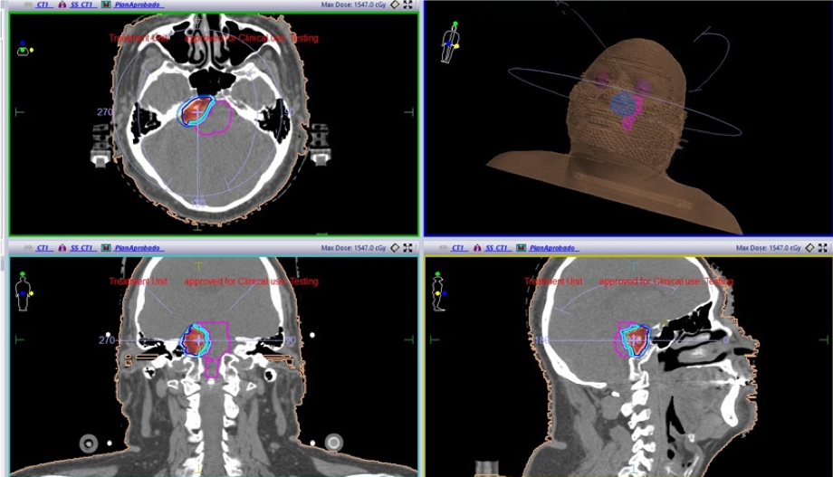 Plan dosimétrico de radiocirugía intracraneal estereotáxica sobre cortes de tomografía